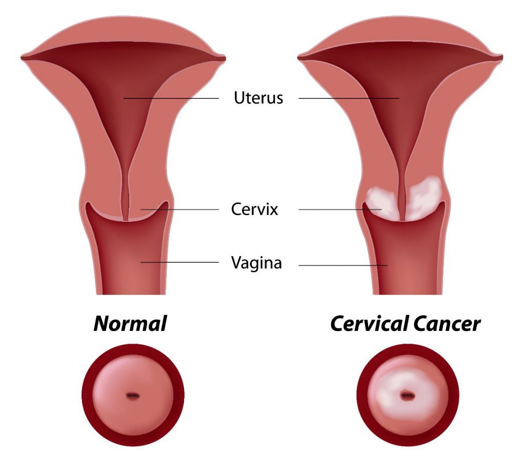 cervical cancer symptoms