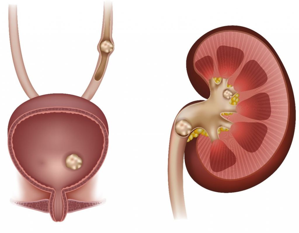 Major Kidney Stone Symptoms