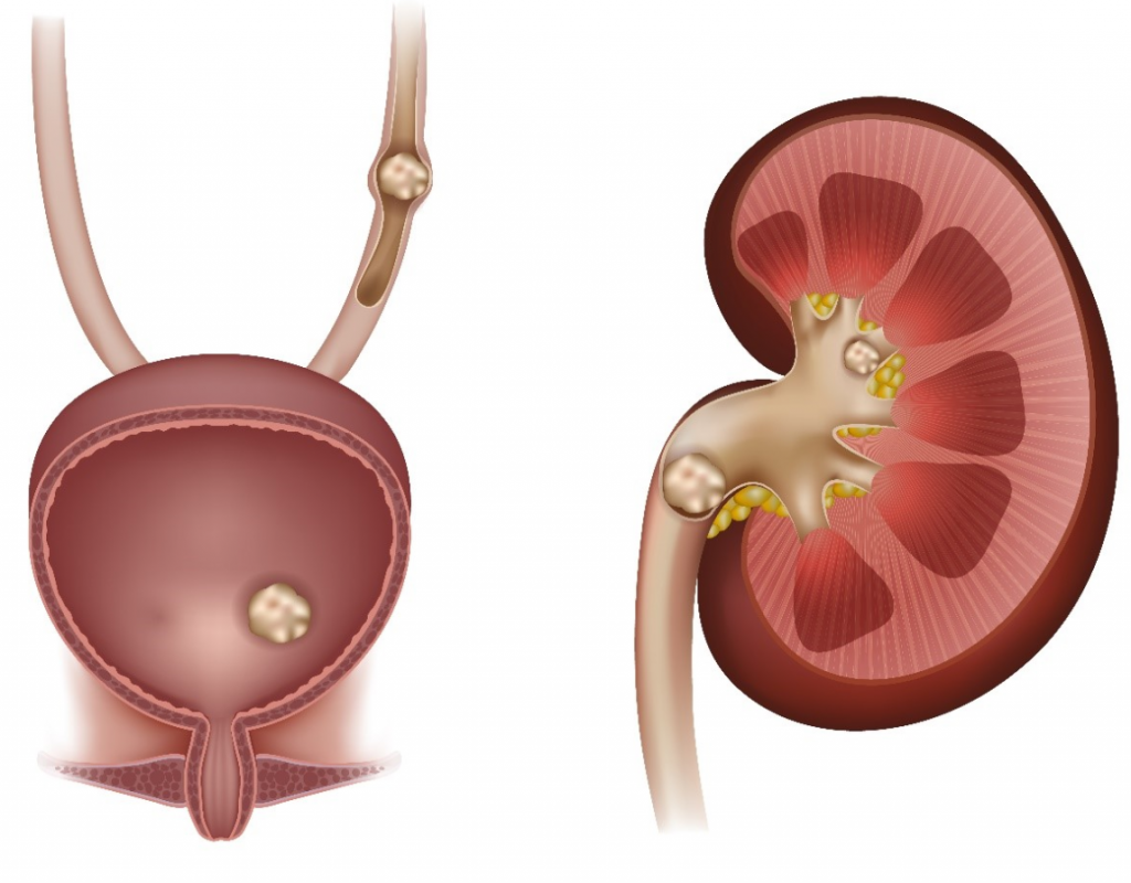 Kidney Stone Size Chart