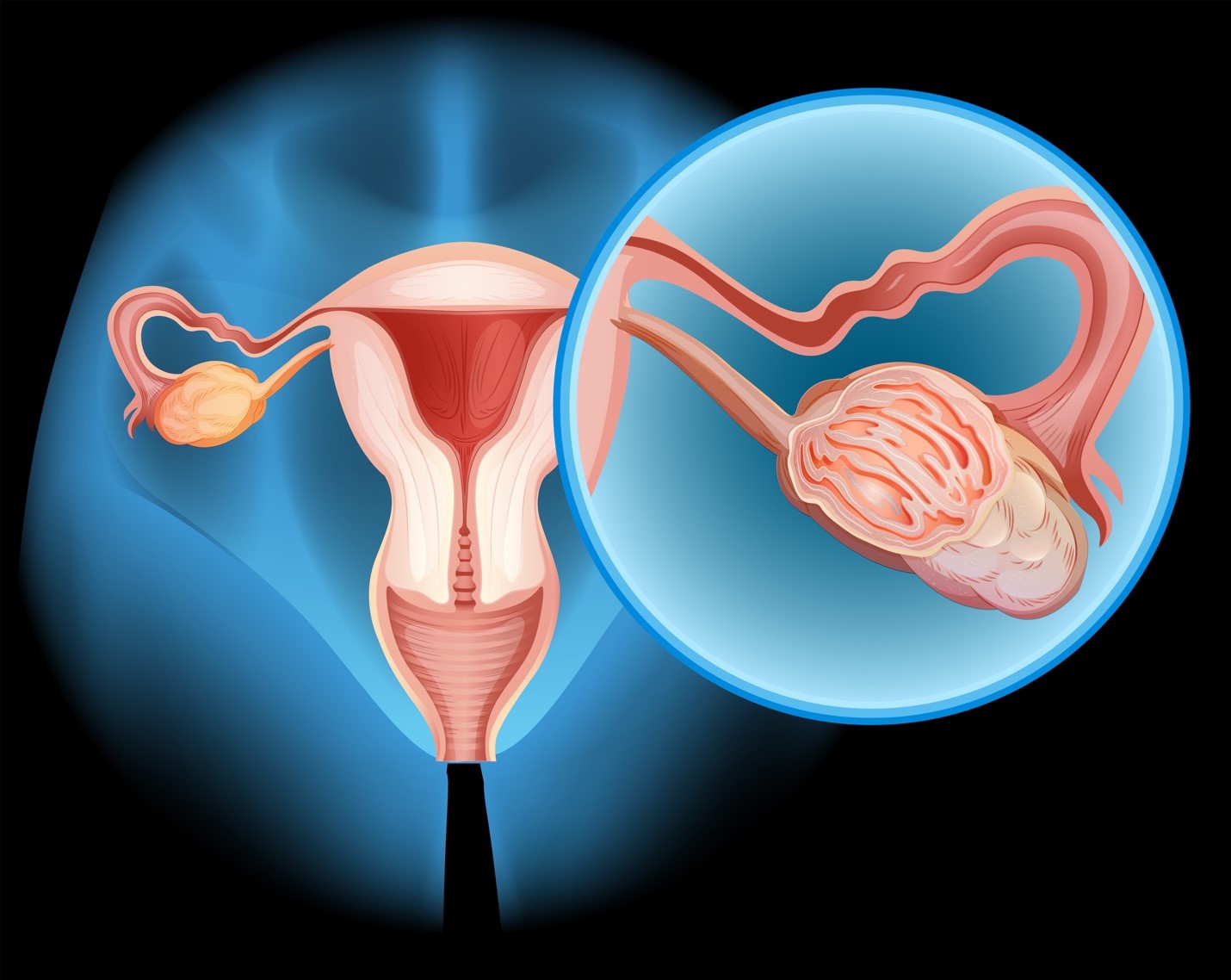 ovarian cancer