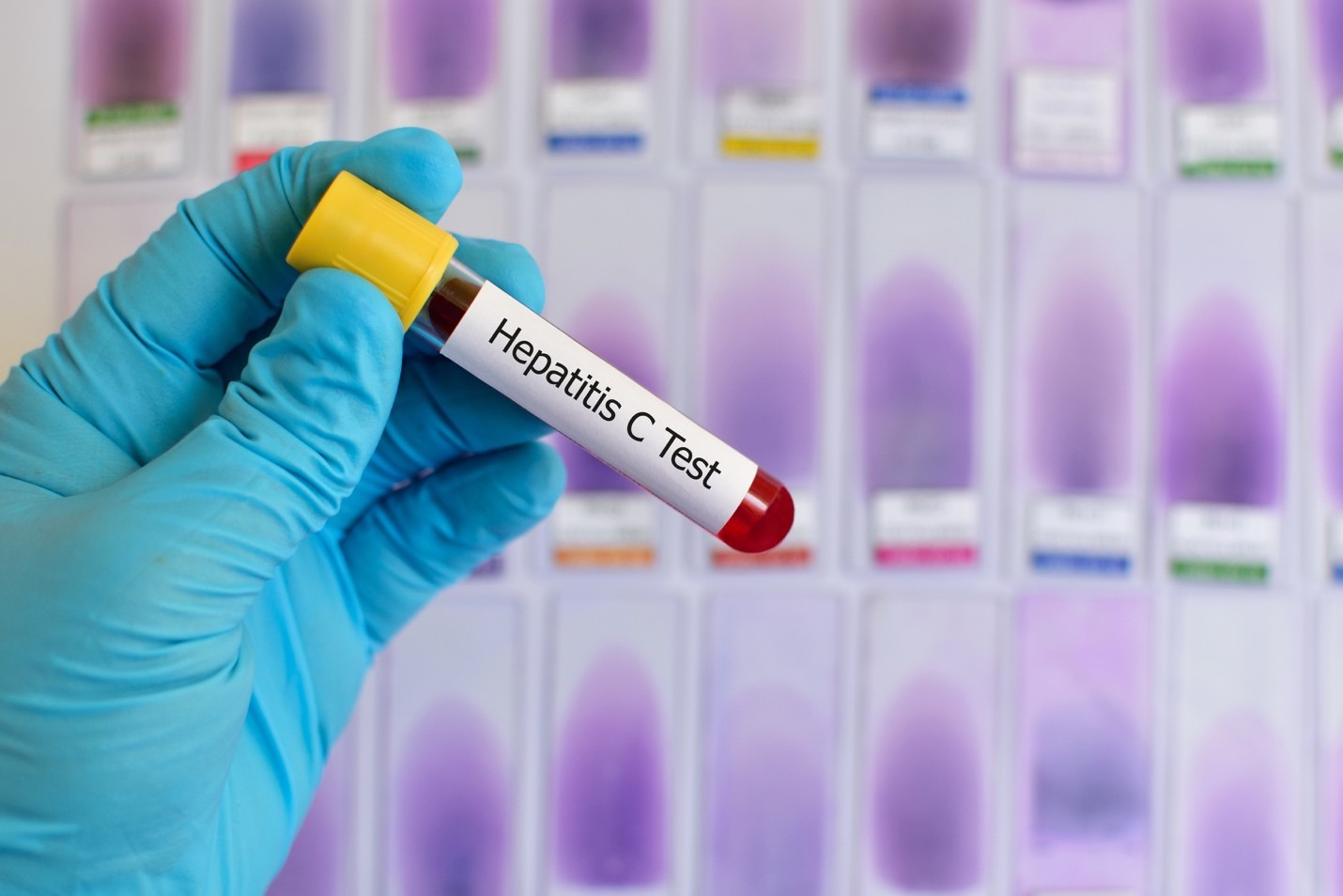 Hepatitis C