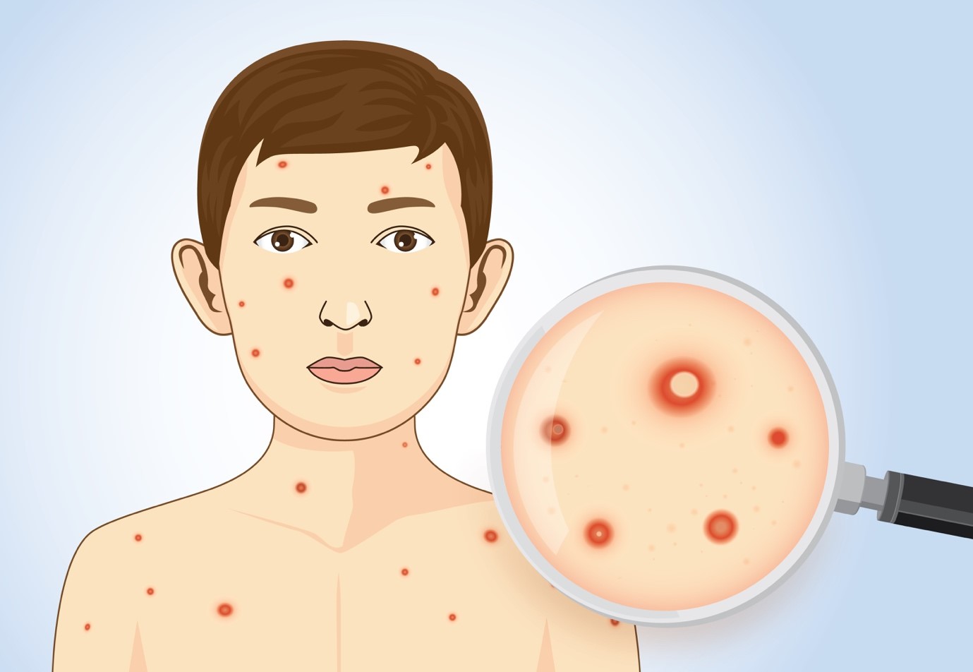 chicken pox pictures in adults