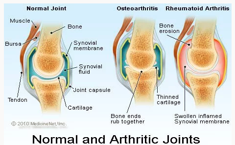 arthritic joints
