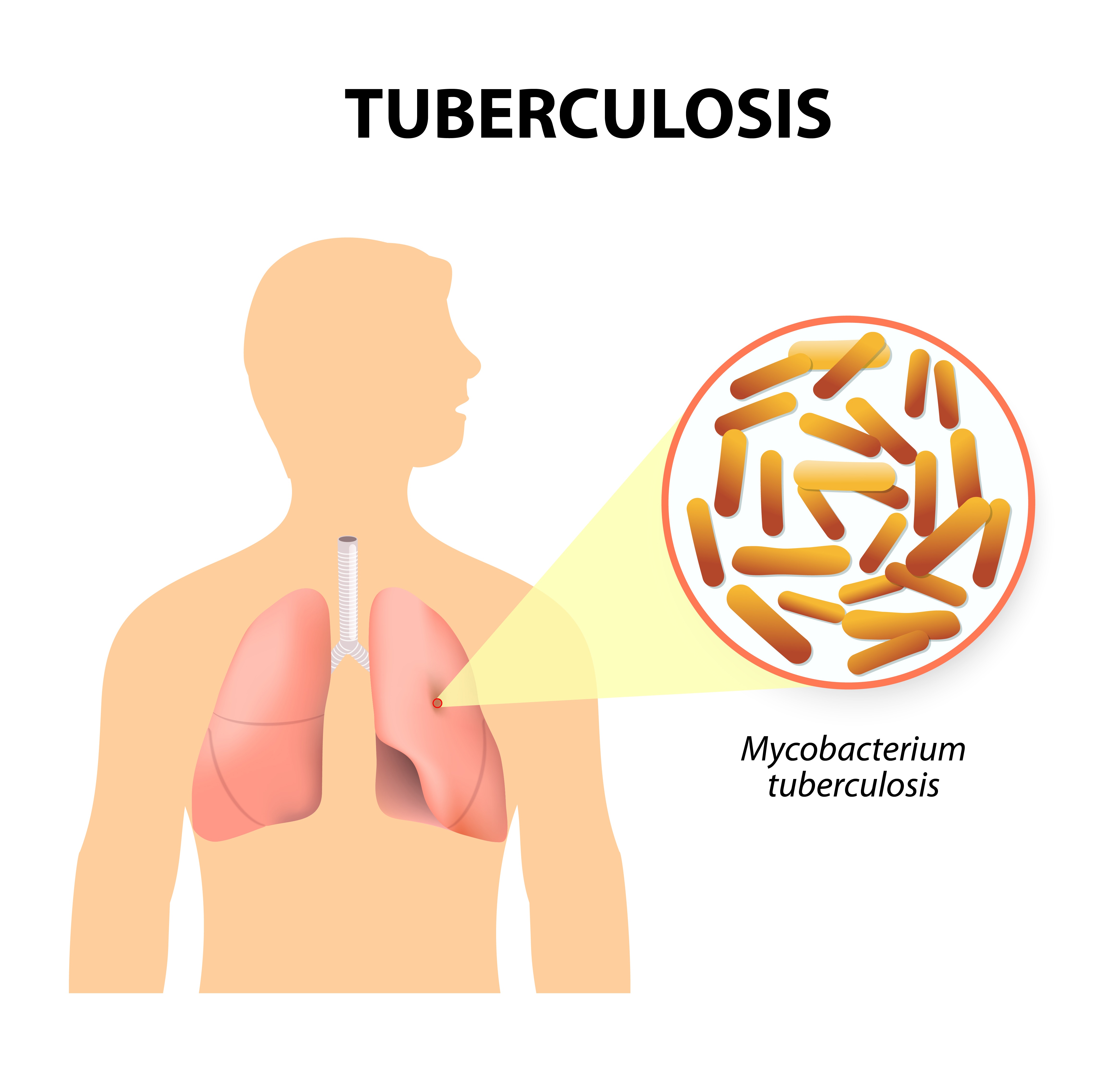 Tuberculosis (TB)
