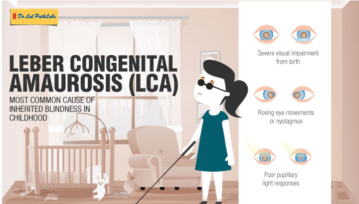 Leber Congenital Amaurosis (LCA) - Inherited Childhood Blindness