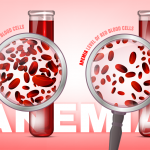 An Overview of Anemia: Types, Symptoms, Risk Factors, Complications, Prevention, Diagnosis & its Treatment