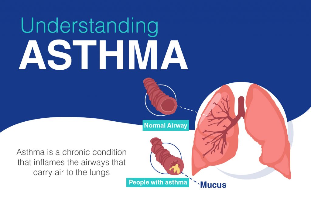 Understanding Asthma – Causes, Symptoms, and Treatment 