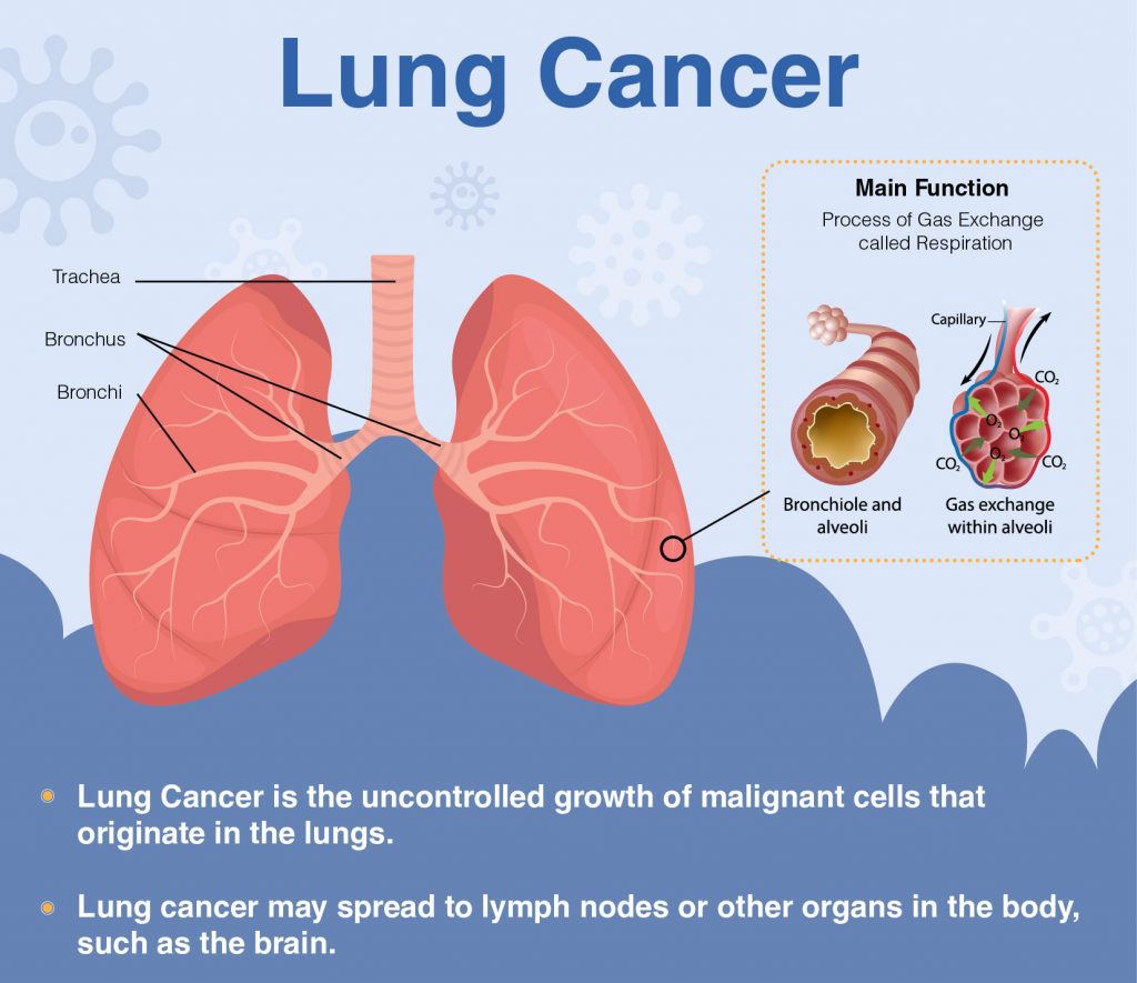 Lung Cancer: Signs, Symptoms, Diagnosis & Treatment