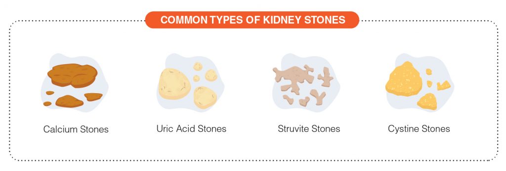 Types of Kidney stones
