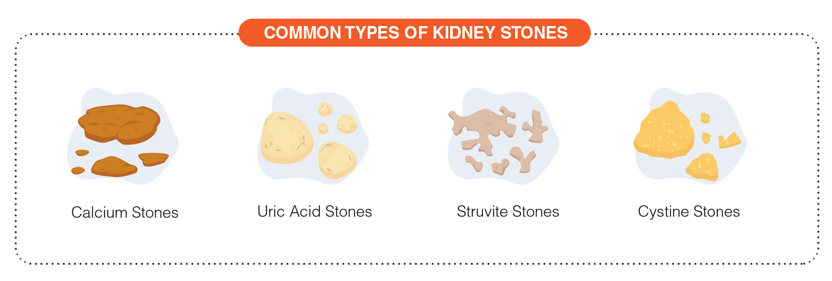 Kidney Stones Colors Types