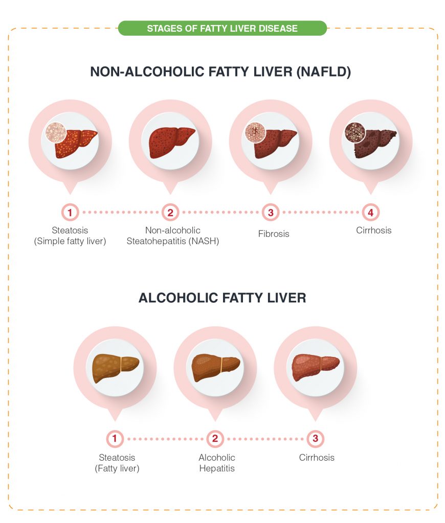 stages of fatty liver