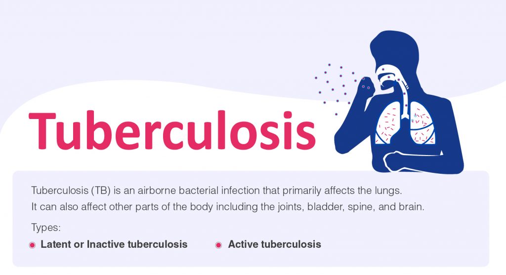 Tuberculosis – Signs and Symptoms