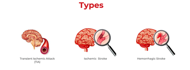 Types of stroke 