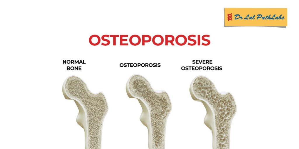 Osteoporosis Symptoms, Causes, Tests & Treatment Dr. Lal PathLabs