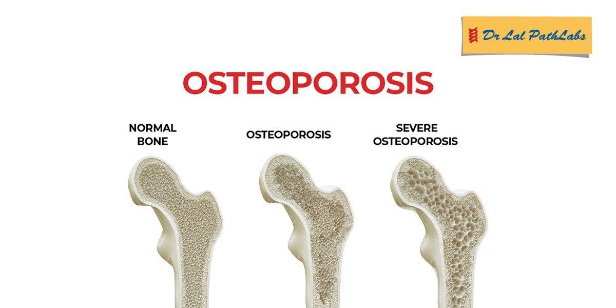 osteoporosis