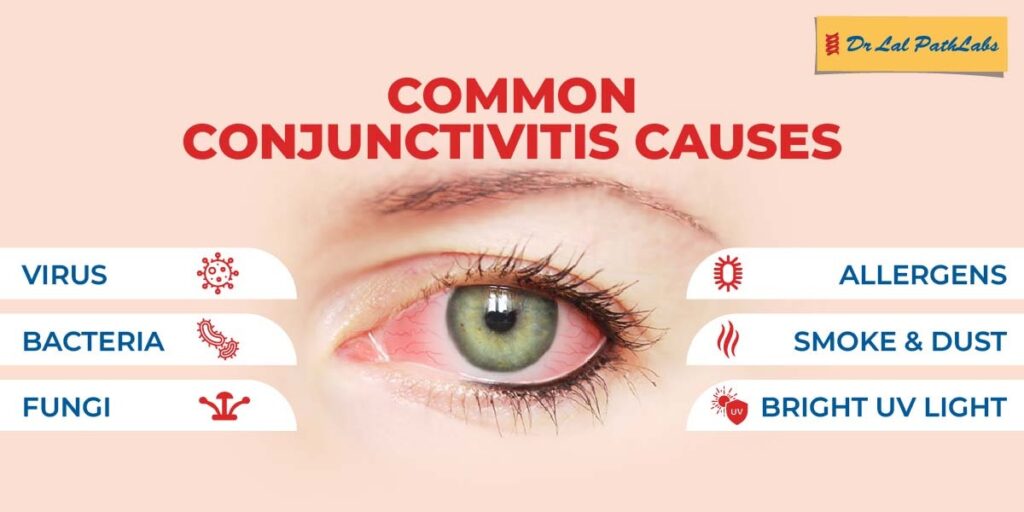 Conjunctivitis: Causes, Symptoms, and Types 
