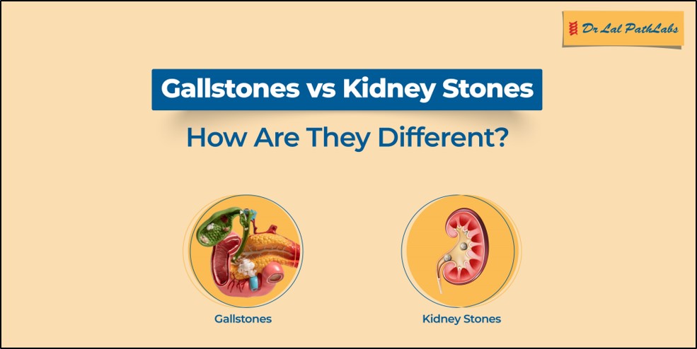 gallstones-kidney-stones