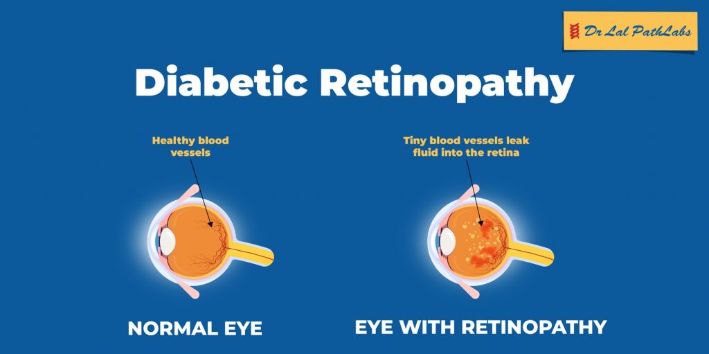 Diabetic Retinopathy