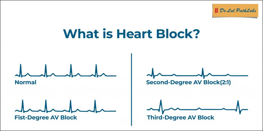 Heart Block