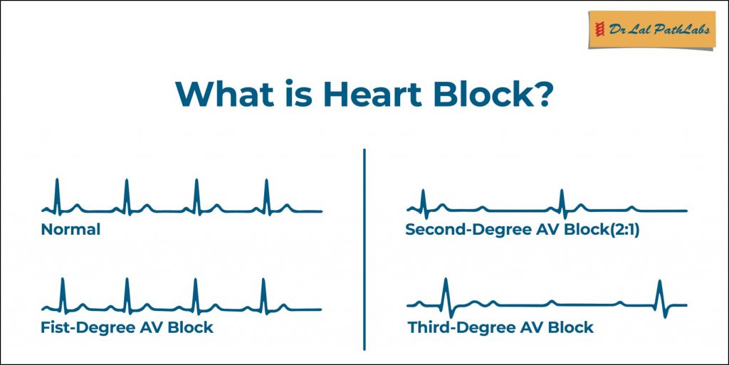 Third degree heart block: Symptoms and treatment