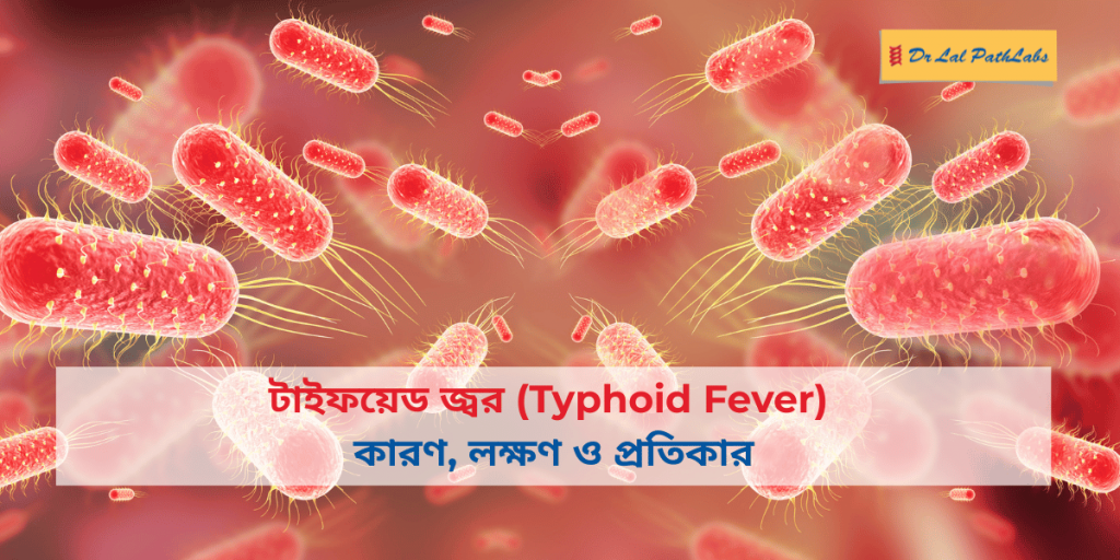 টাইফয়েড জ্বর: কারণ, লক্ষণ ও প্রতিকার