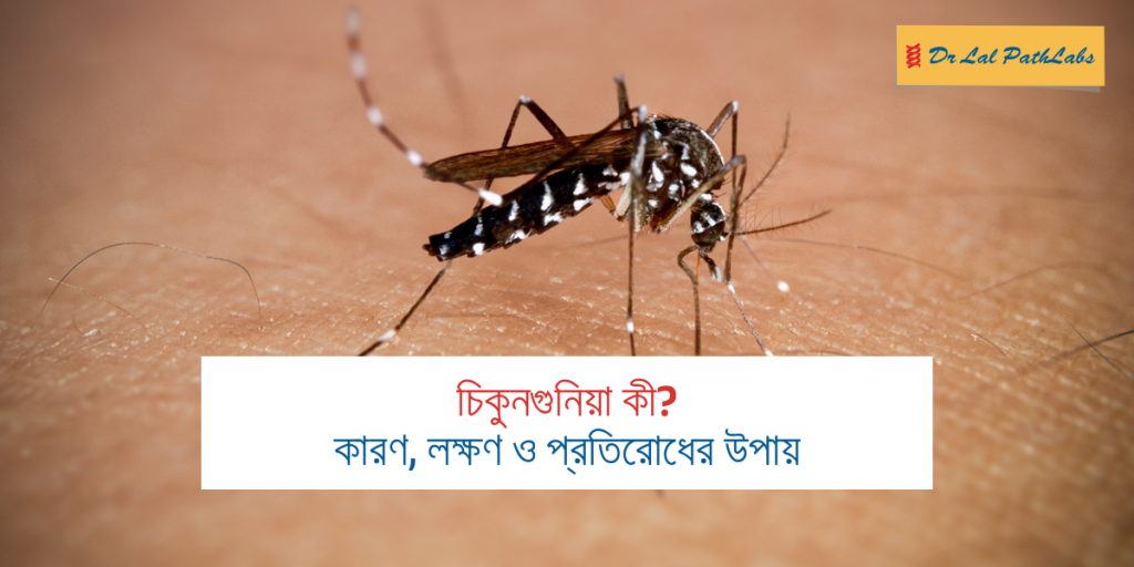 চিকুনগুনিয়া কী? কারণ, লক্ষণ ও প্রতিরোধের উপায়