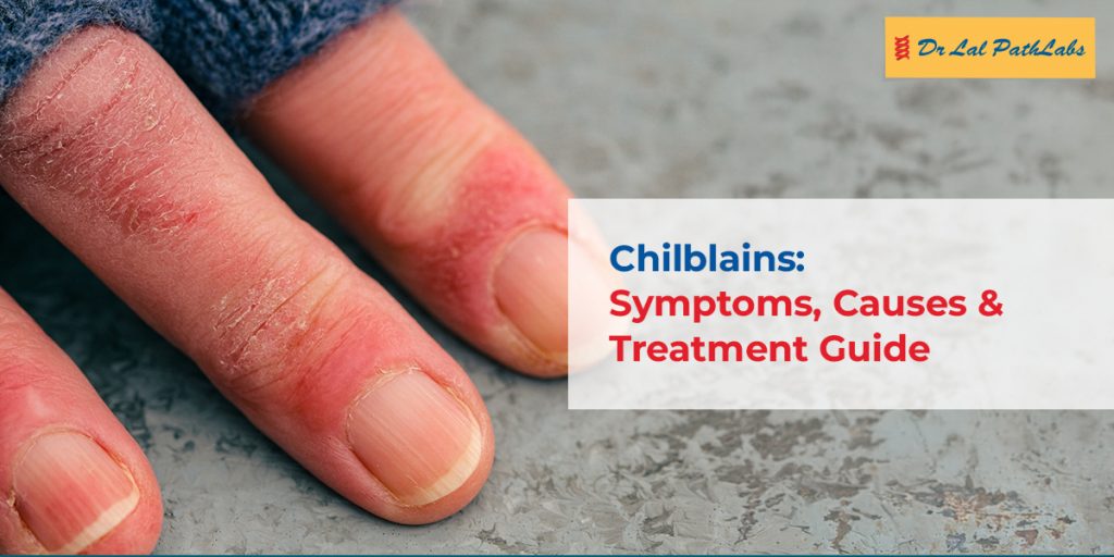 Chilblains: Symptoms, Causes & Treatment Guide