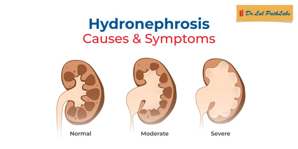 What is Hydronephrosis? Symptoms, Causes, and Treatment Explained