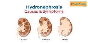 hydronephrosis causes & symptoms