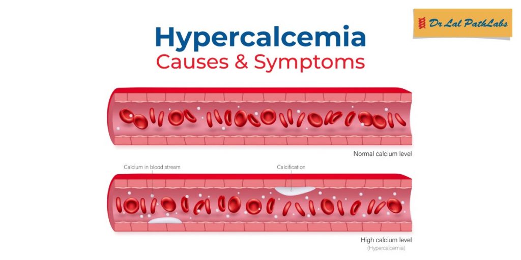 Hypercalcemia: Symptoms, Causes & Treatment