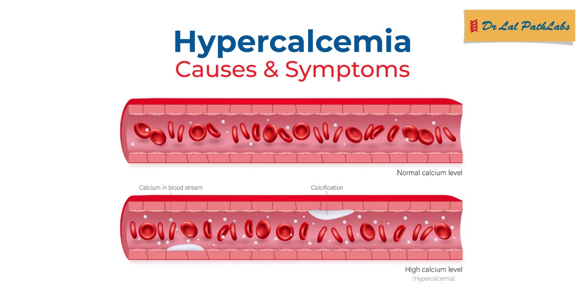 hypercalcemia