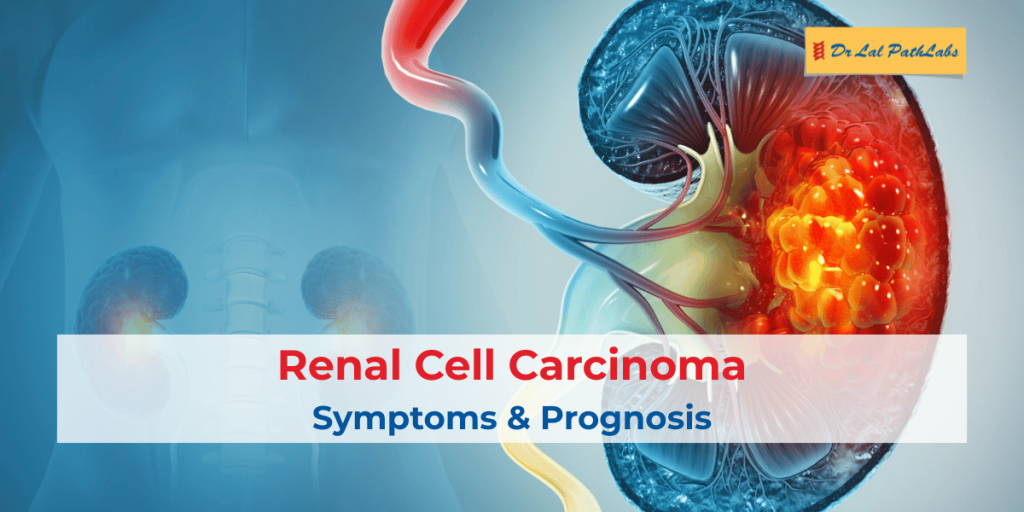 Renal Cell Carcinoma: Symptoms & Prognosis