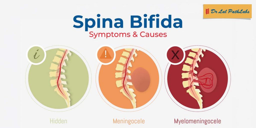 Spina Bifida: Symptoms, Causes, Treatment