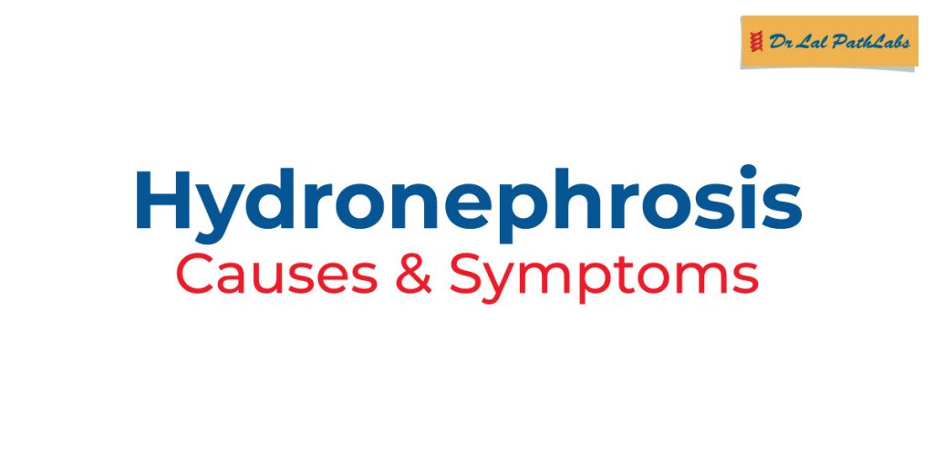 hydronephrosis