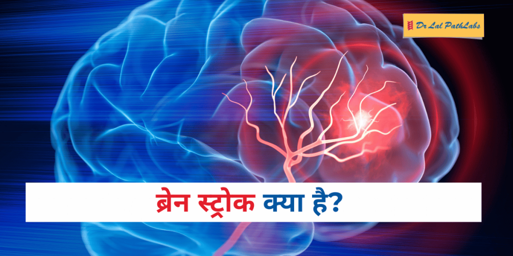 ब्रेन स्ट्रोक क्या है? कारण, लक्षण और बचाव के उपाय