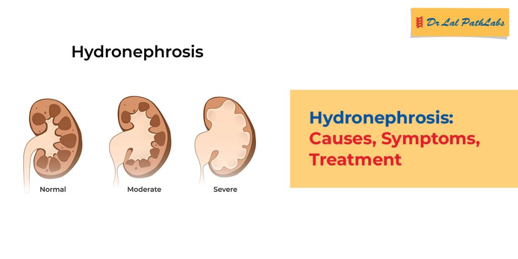 Understanding Hydronephrosis: Causes, Symptoms & Treatment