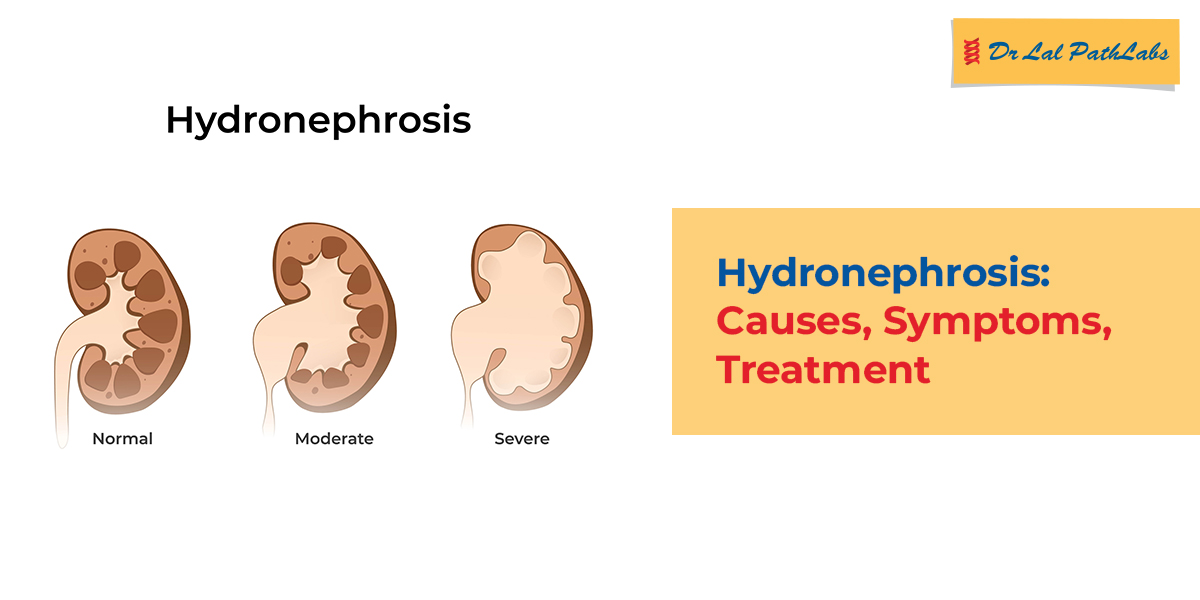 Understanding Hydronephrosis