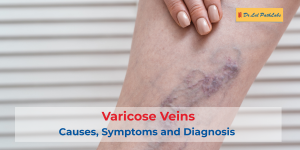 Varicose Veins