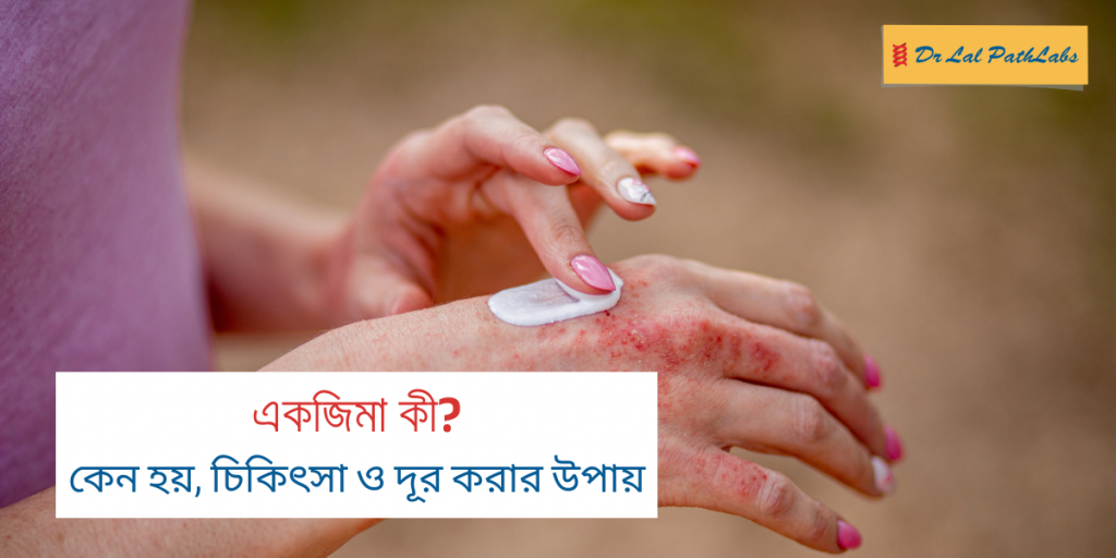 একজিমা: কারণ, চিকিৎসা ও প্রতিকার