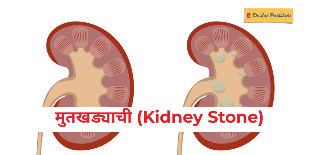 मुतखड्याची लक्षणे, कारणे आणि प्रतिबंध