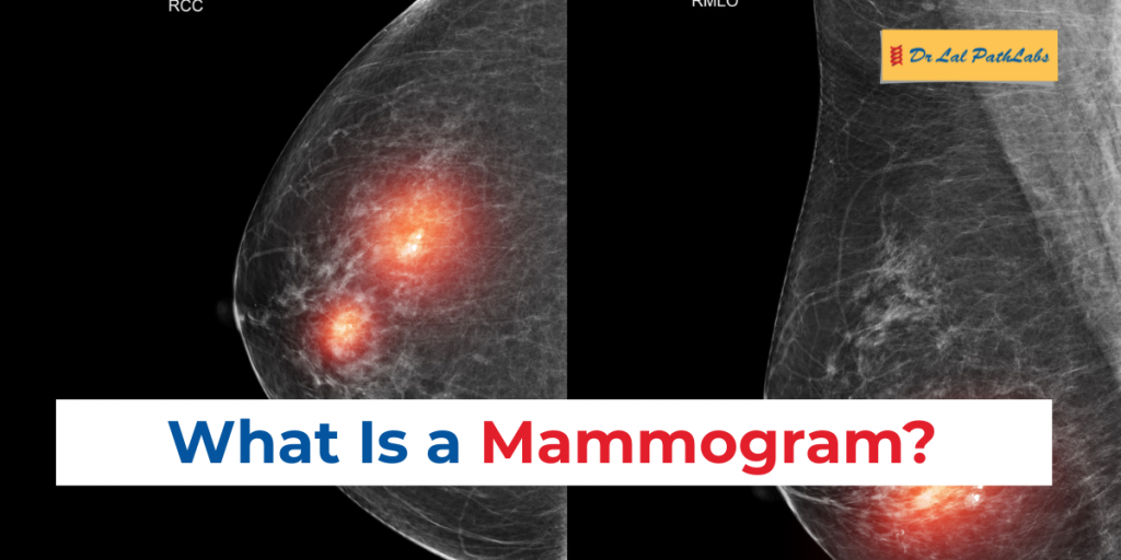 Mammography