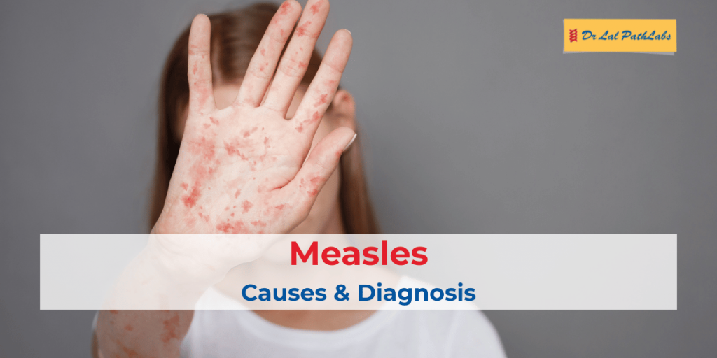 Causes and Symptoms of Measles: Diagnosis & Treatment Explained