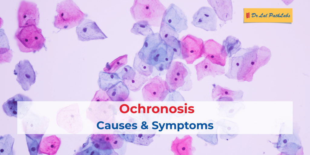 Ochronosis: Causes, Symptoms & Diagnosis Explained