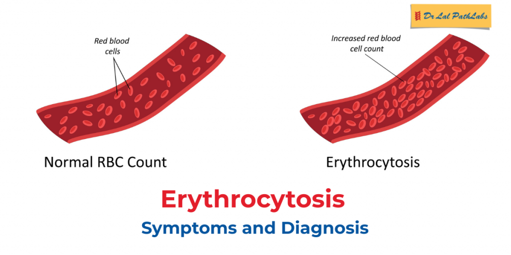 Erythrocytosis