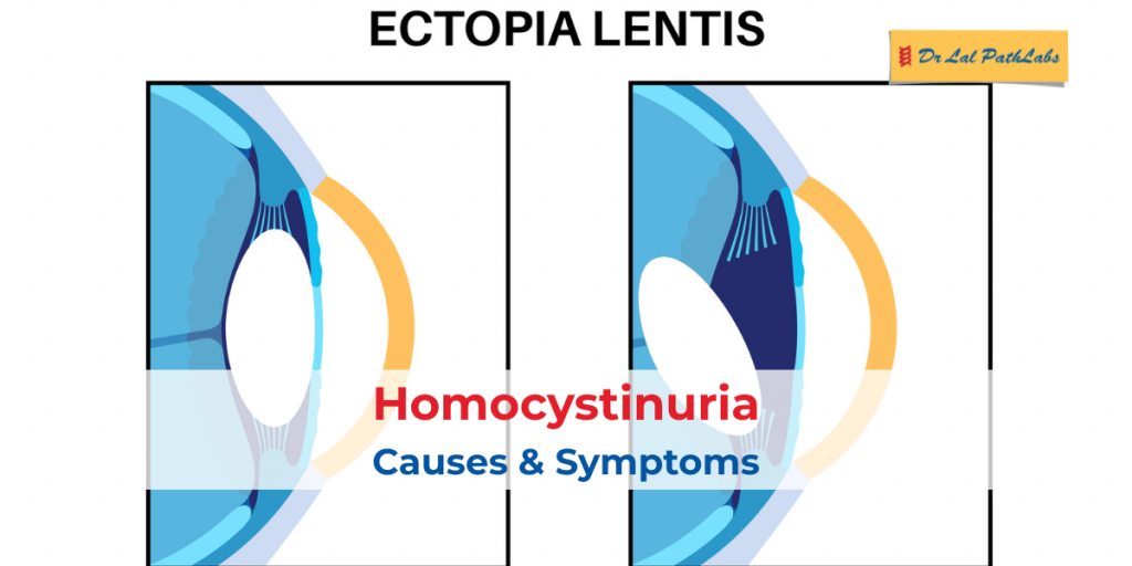 Homocystinuria: Causes, Symptoms, Diagnosis & Treatment Explained