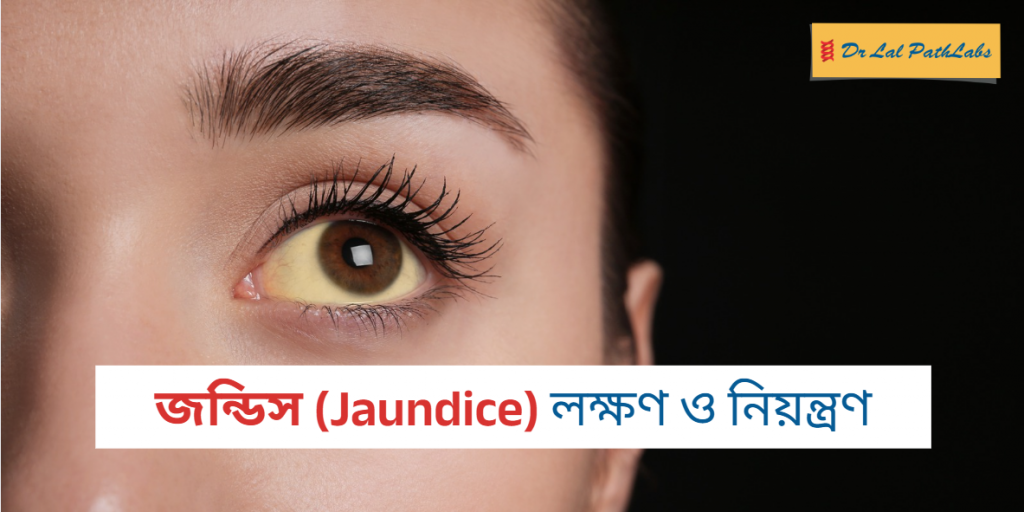 কেন জন্ডিস হয়? জেনে নিন লক্ষণ, প্রতিকার ও জন্ডিস কমানোর উপায়