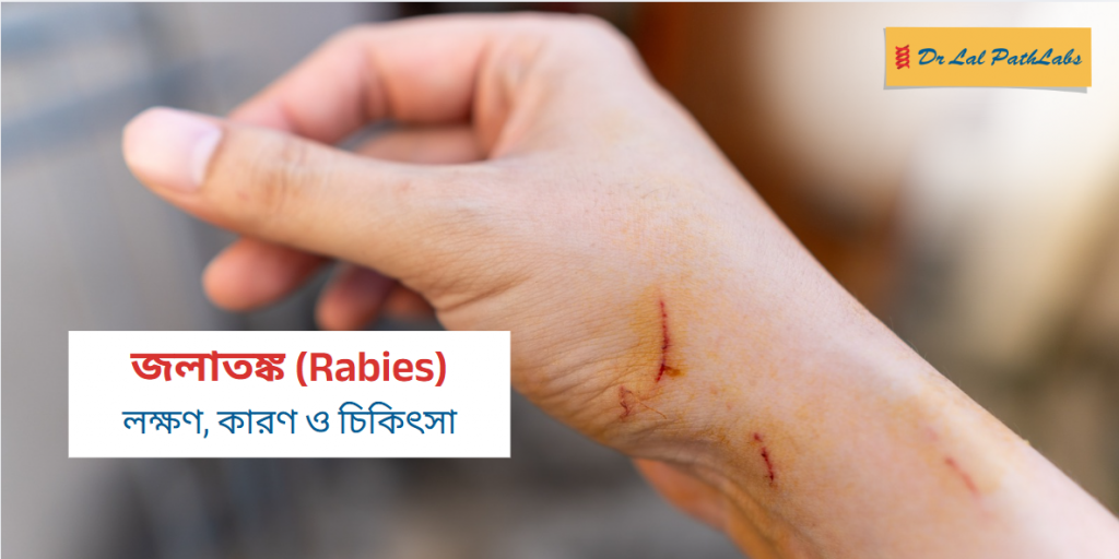 রেবিসের উপসর্গ কী? রেবিসের কারণ, উপসর্গ ও চিকিৎসা ব্যাখ্যা করা হলো