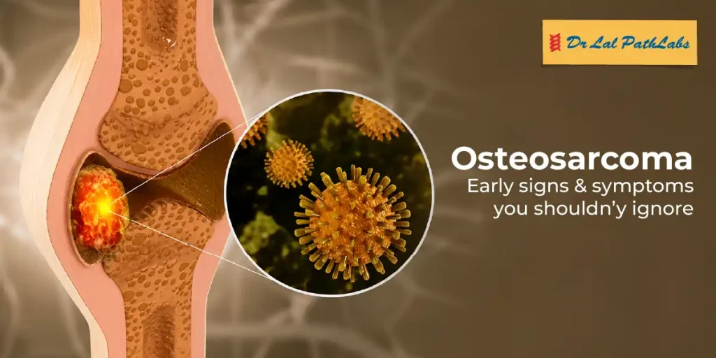 What Is Osteosarcoma? Early Signs and Symptoms You Shouldn’t Ignore