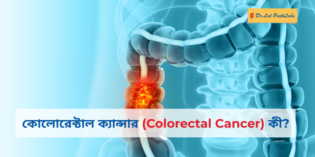 Colorectal cancer in bengali