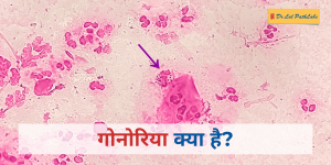 Gonorrhea in hindi